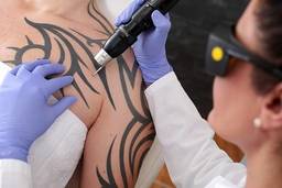 The truth about laser tattoo removal machines