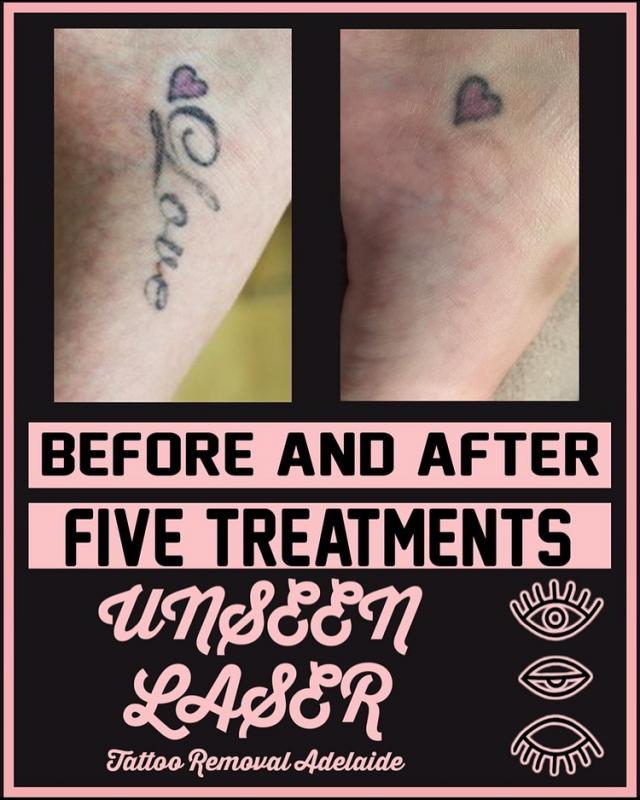 Unseen Laser Tattoo Removal - Tattoo Removal Services - BeautifulMe