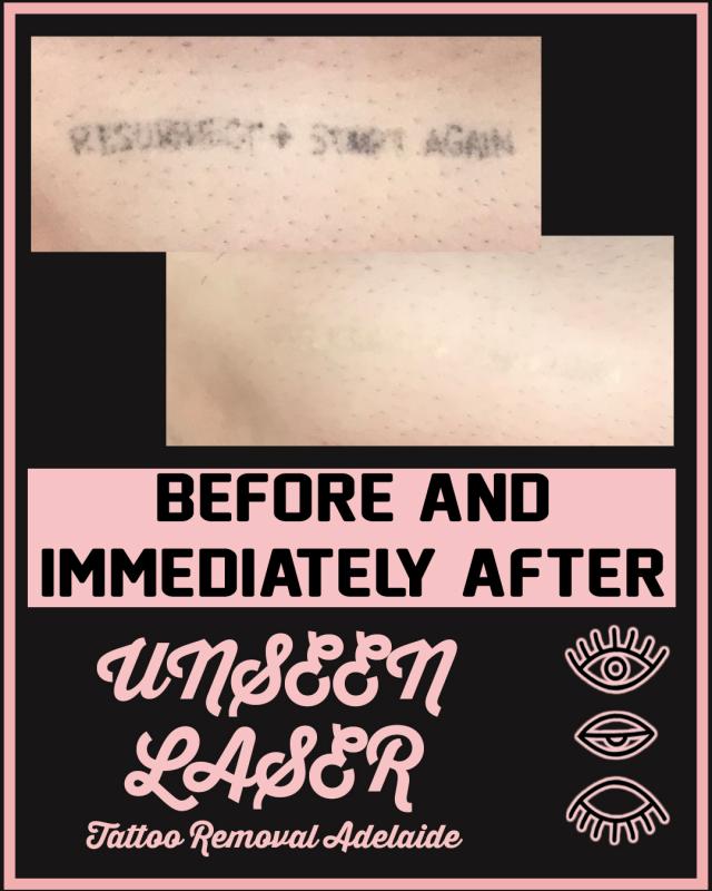 Unseen Laser Tattoo Removal - Tattoo Removal Services - BeautifulMe